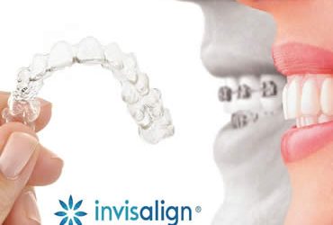 Invisalign versus Metal Braces